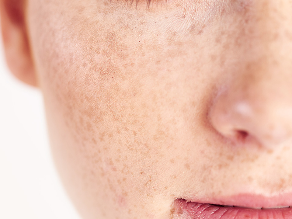 Close-up von Haut mit Sommersprossen